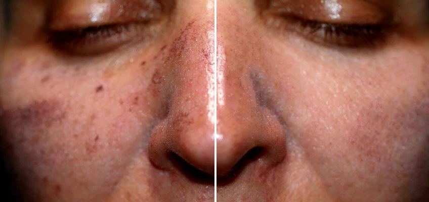 Melasma - matlabs cosmetics morocco